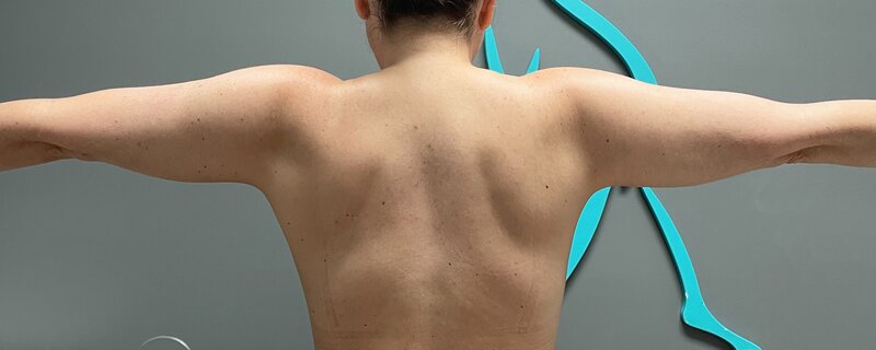 Sculptra Before & After Image